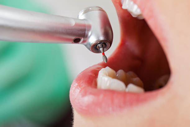 Best Emergency Dental Extractions in Mart, TX